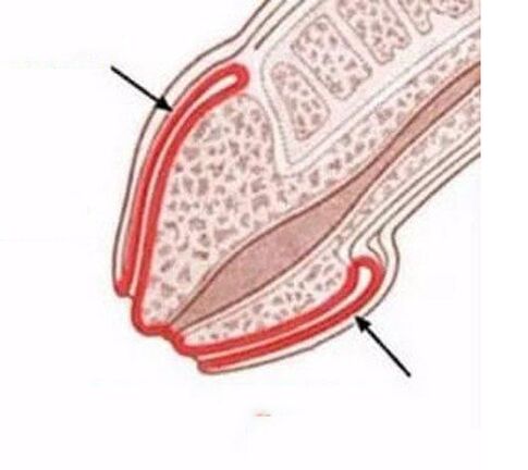 Infiammazione del pene