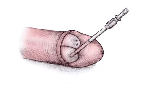 La testa del pene può essere ingrandita iniettandovi del gel ialuronico