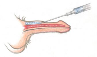Iniezione volumizzante di acido ialuronico nel pene